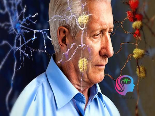 راه های پیشگیری از ابتلا به آلزایمر