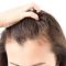 ریزش مو پس از عمل لاغری: دلایل و راهکارها