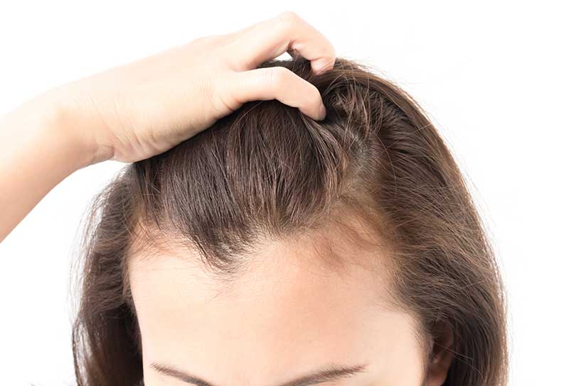 ریزش مو پس از عمل لاغری: دلایل و راهکارها