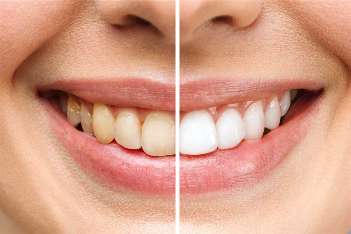 رفع همه ابهام ها در مورد سفید کردن دندان ها با بلیچینگ