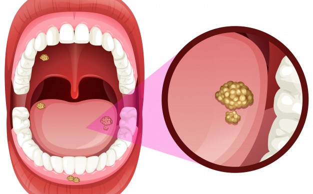 روش های تشخیص سرطان دهان