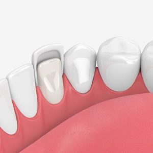 لمینت دندان موجب پوسیدگی دندان می شود؟